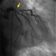 IVUS−VH 研究活動