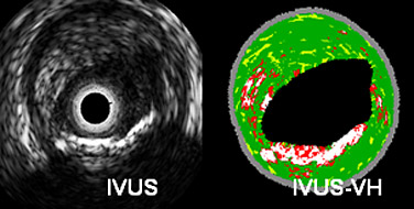 IVUS−VH 研究活動