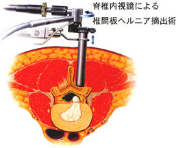 脊椎内視鏡による椎間板ヘルニア摘出術