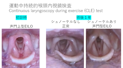 運動中持続的喉頭内視鏡検査の写真