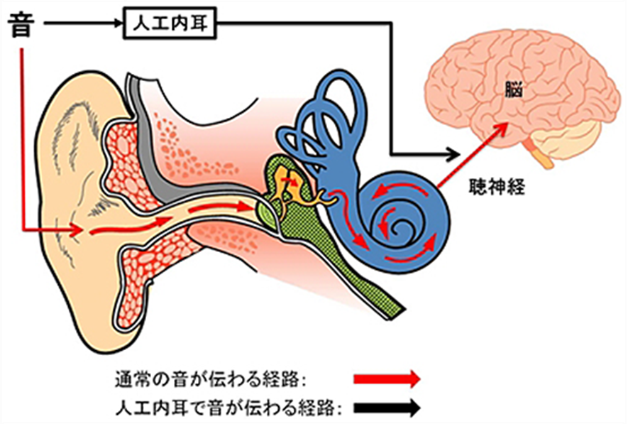 通常の音が伝わる経路と人工内耳で音が伝わる経路の図