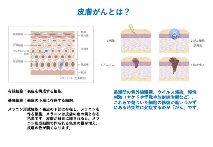 皮膚がんとは？