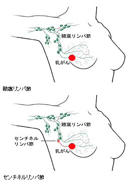 乳がんの診断と治療 和歌山県立医科大学附属病院紀北分院