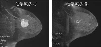 乳がんの診断と治療 和歌山県立医科大学附属病院紀北分院