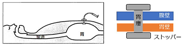 経皮内視鏡的胃瘻造設術（percutaneous endoscopic gastrostomy : PEG）