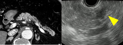 左：CT画像、右：EUS画像