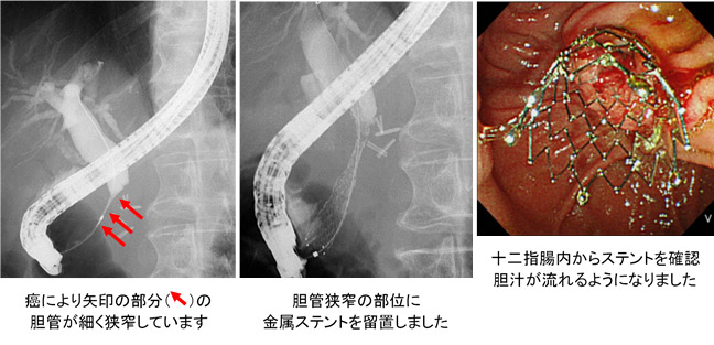 ステントによる治療