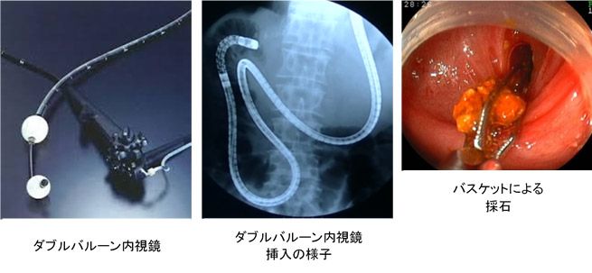 ダブルバルーン内視鏡を併用したERCP（DB-ERCP）