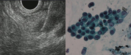 左：EUS画像　右：細胞診
