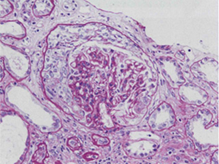 病理図2　腎炎・ネフローゼ症候群