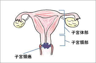 子宮頸がん