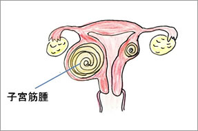 子宮筋腫