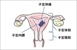 子宮体がん