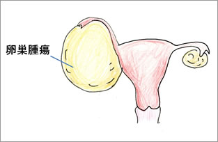 卵巣腫瘍