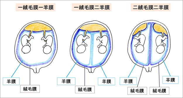 多胎妊娠