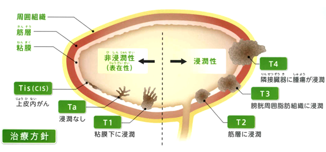 画像：膀胱がんの浸潤形式