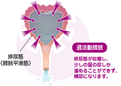 画像：過活動膀胱