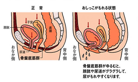 画像：腹圧性尿失禁