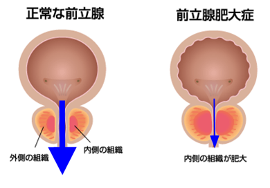 画像：前立腺肥大症