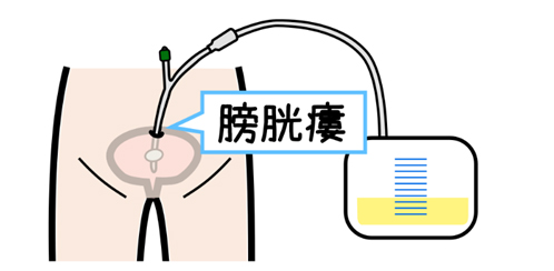 膀胱瘻