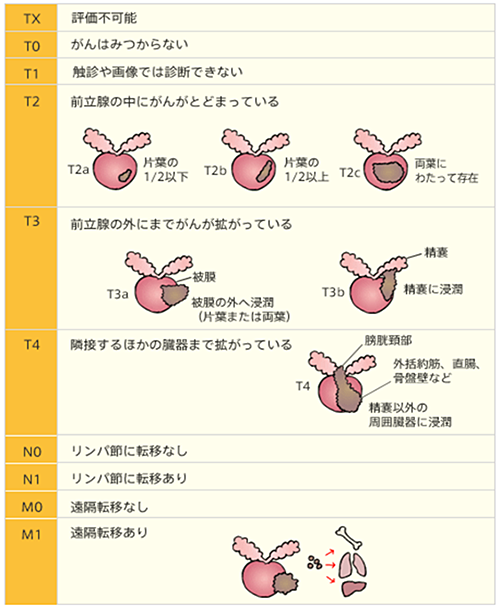 TNM分類