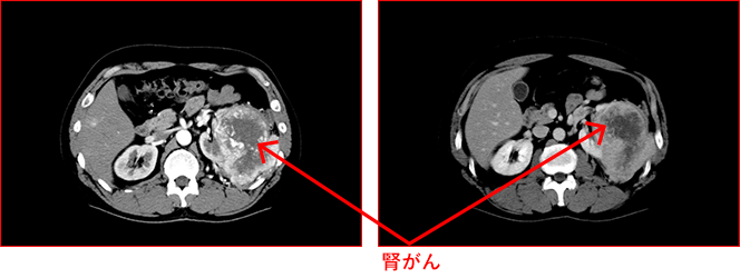 CT画像（腎がん）
