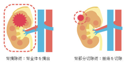 腎摘除術：腎全体を摘出
腎部分切除術：腫瘍を切除